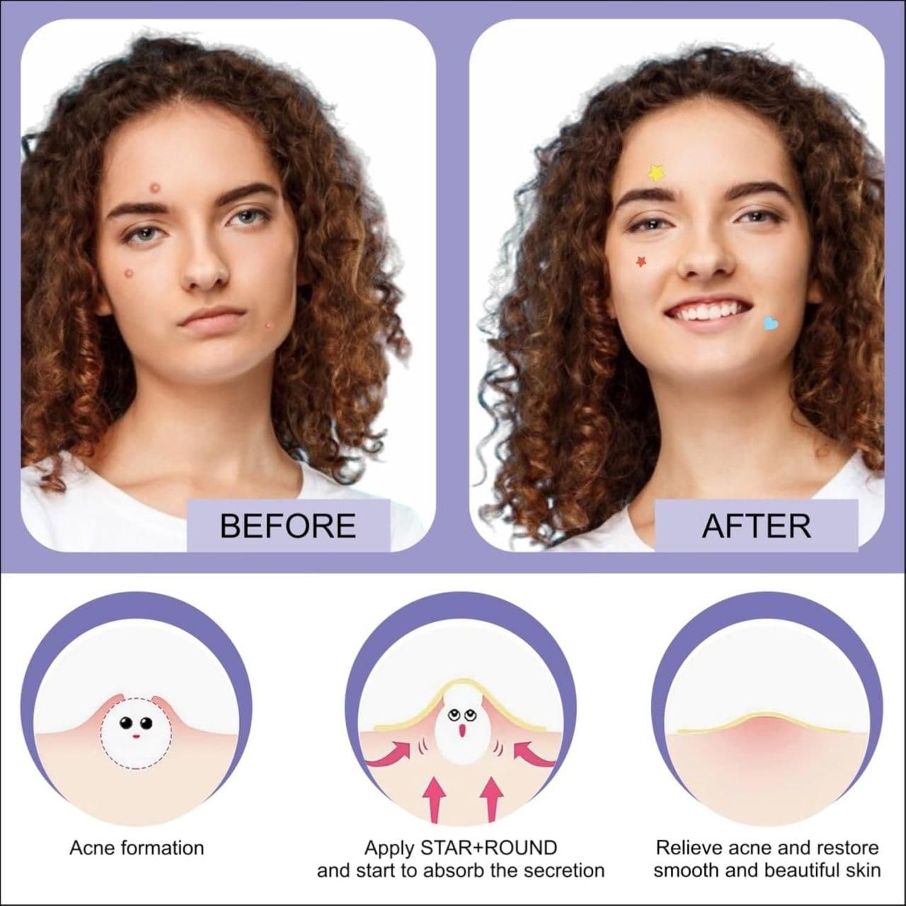 180 Pcs Pimple Patches